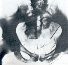 Seamless mirror wallpaper pattern — Medicine by wallpaper⁶ — base photo: File:Pelvis of Albert Fish (X-ray).jpg